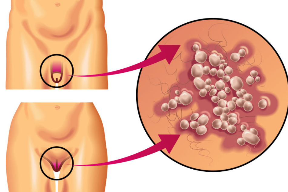 Genitalherpes ist eine sexuell übertragbare Erkrankung, die durch das Herpes simplex-Virus Typ 2 verursacht wird.