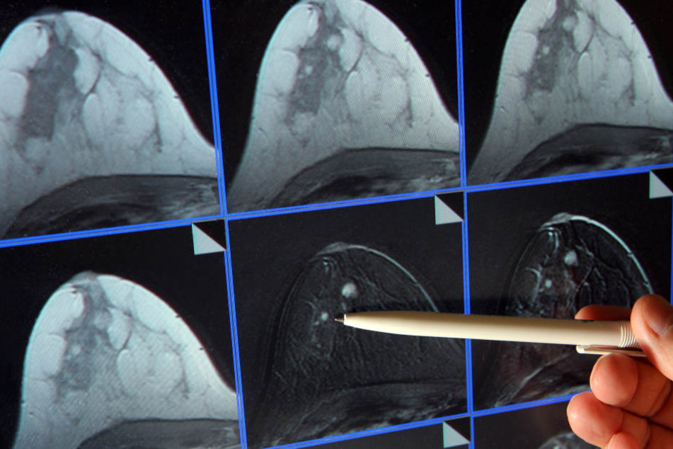 Brustkrebs-Früherkennung: Auf der Bildschirmdarstellung einer Magnetresonanz-(MR)-Mammographie ist ein winziger Tumor in der Brust einer Patientin zu sehen.