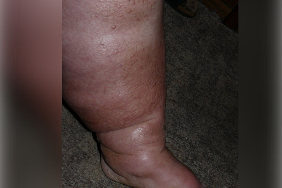 Im Extremfall kann das Lipödem für ein massives Anschwellen der Beine verursachen.