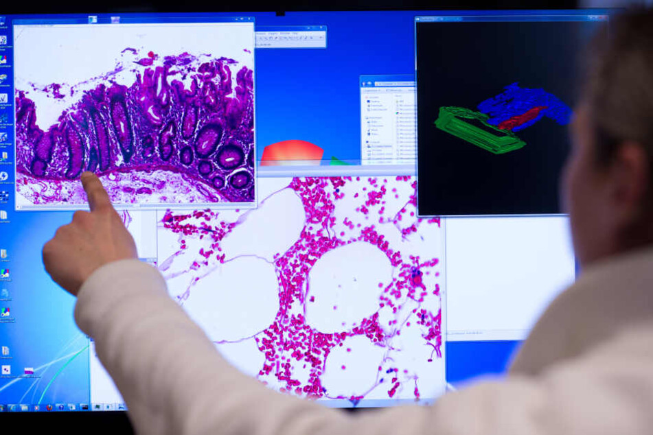 Krebs-Diagnostik: Darstellung einer Gewebeprobe aus dem Dickdarm.