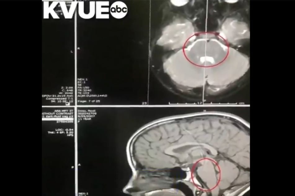 Auf den jüngsten MRT-Scans war kein Tumor mehr zu sehen.