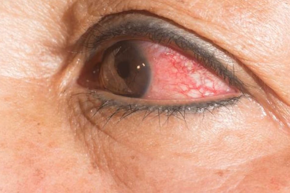 14 Würmer in einem Auge mussten im Februar einer Frau aus den USA entfernt werden.