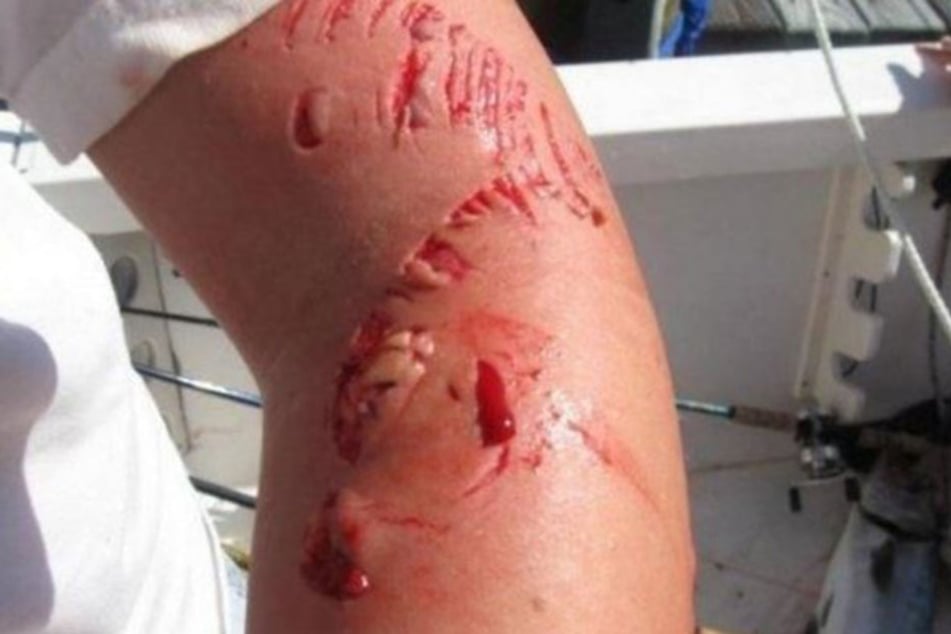 Der Fisch riss im Todeskampf tiefe Wunden in den Arm.