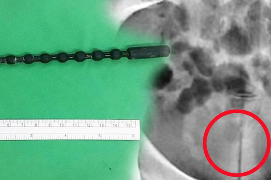 Der Mann führte sich diesen 20 Zentimeter langen Stab in die Harnröhre ein.