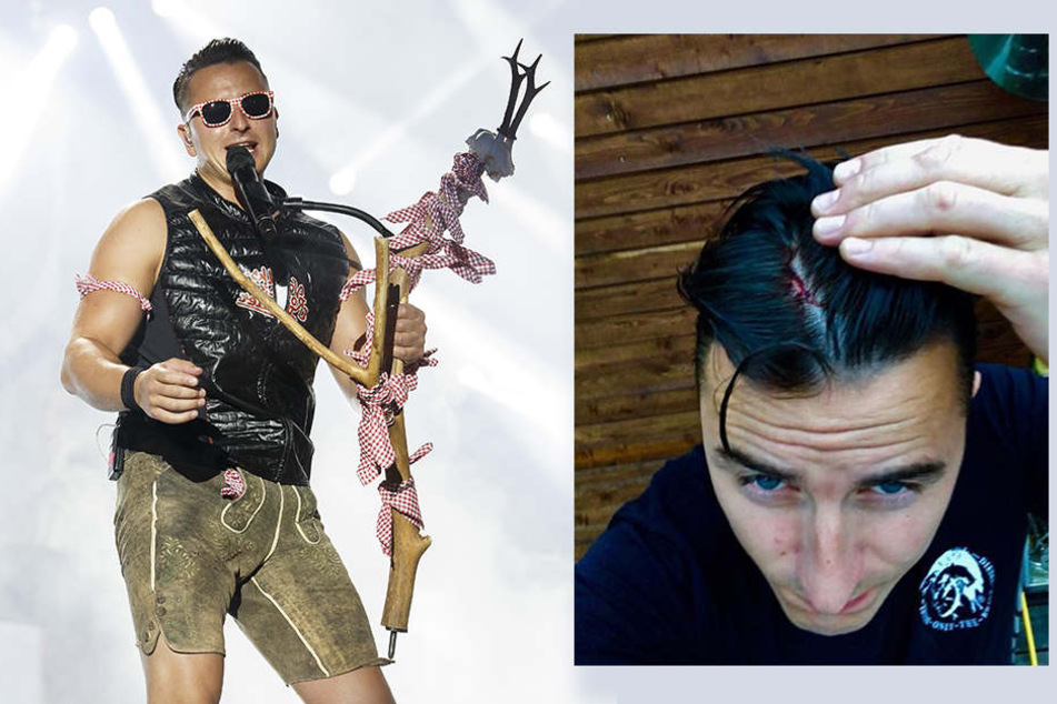 Andreas Gabalier zog sich am Donnerstag eine Kopfverletzung zu und schockierte seine Fans mit blutigem Fotobeweis auf Facebook.