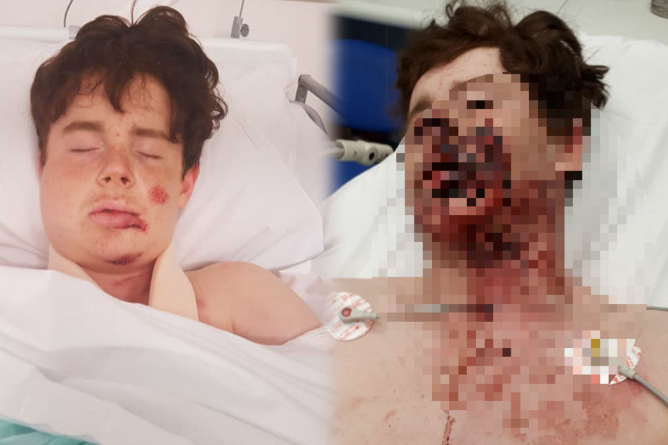 Der Sturz hinterließ bei Mackenzie Cooper (13) deutliche Spuren.