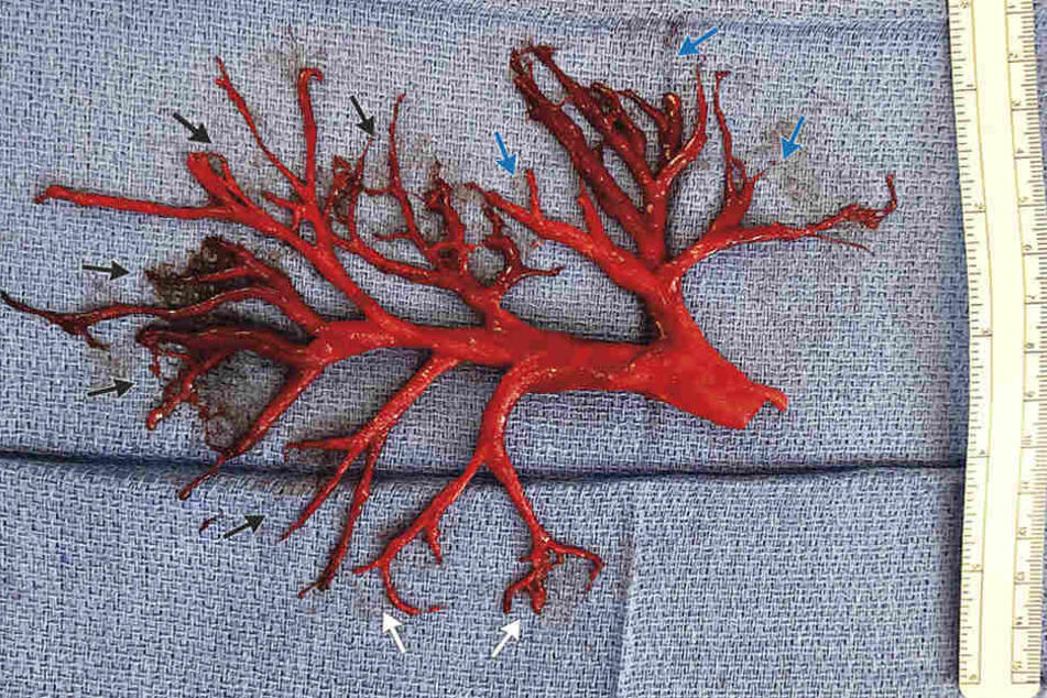 Das "New England Journal of Medicine" veröffentlichte ein Foto des Lungen-Teils.