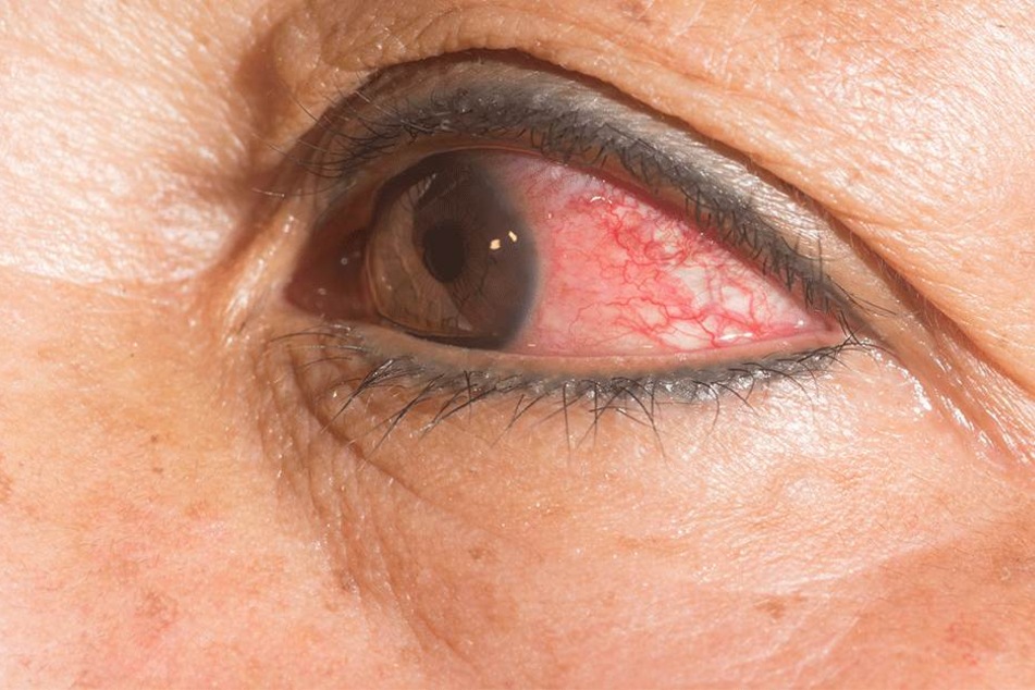 14 Würmer in einem Auge, ein Grauen... (Symbolbild).