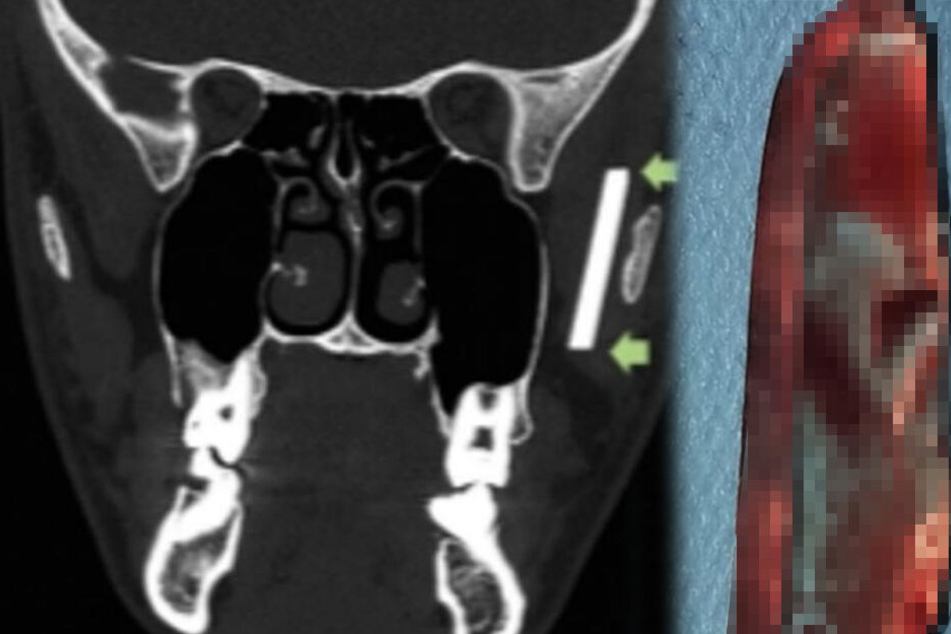 Ein rechteckiges Objekt aus Glas, mit gut 3,5 Zentimetern Seitenlänge befand sich hinter dem Wangenknochen des Patienten versteckt.