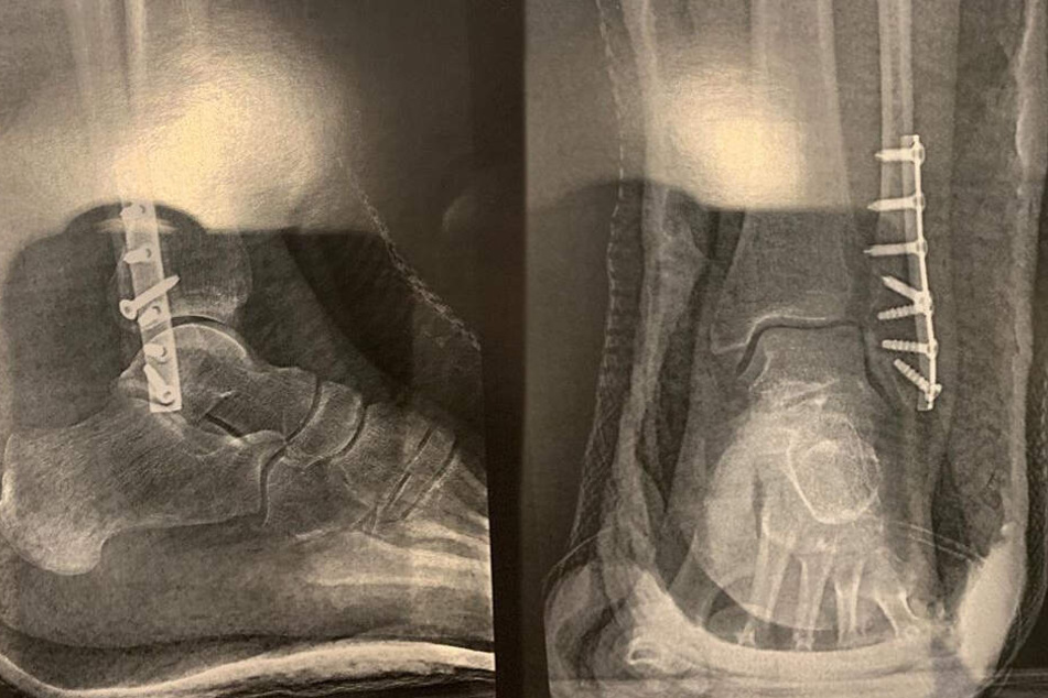 Der gebrochene Fuß von Carmen Geiss wurde mit Metallschrauben verstärkt.