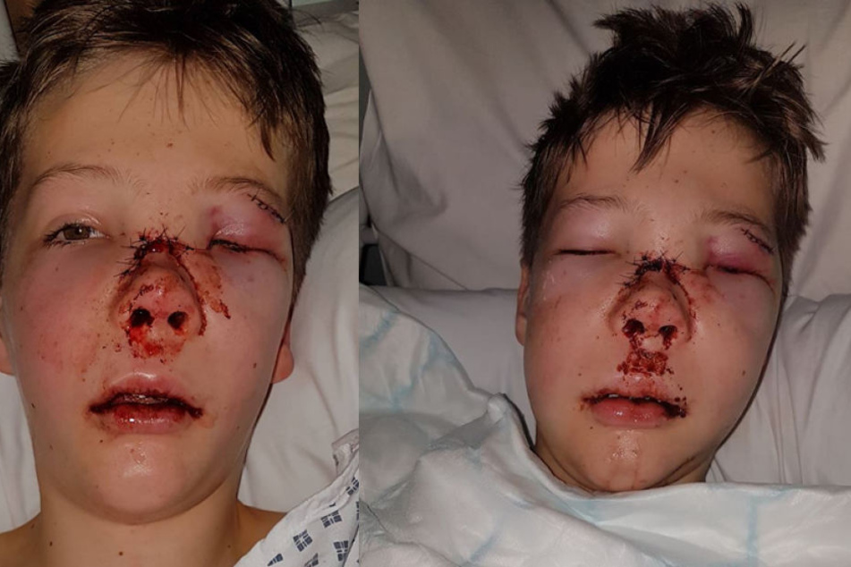 So furchtbar wurde der elfjährige Morgan Davis bei einem Fahrradunfall zugerichtet.