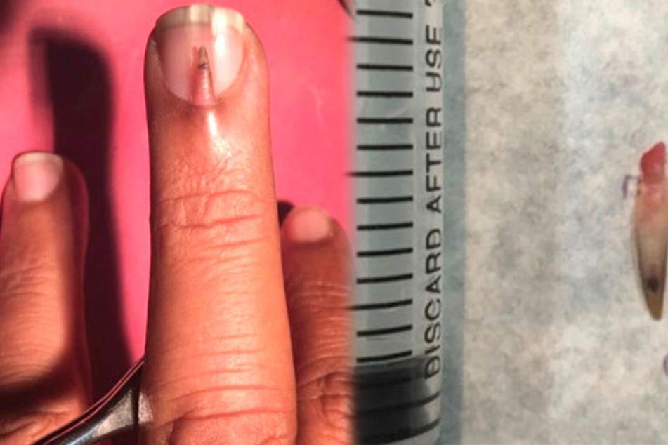 Kein appetitlicher Anblick: Was wächst denn da am Mittelfinger eines Patienten aus Pakistan?