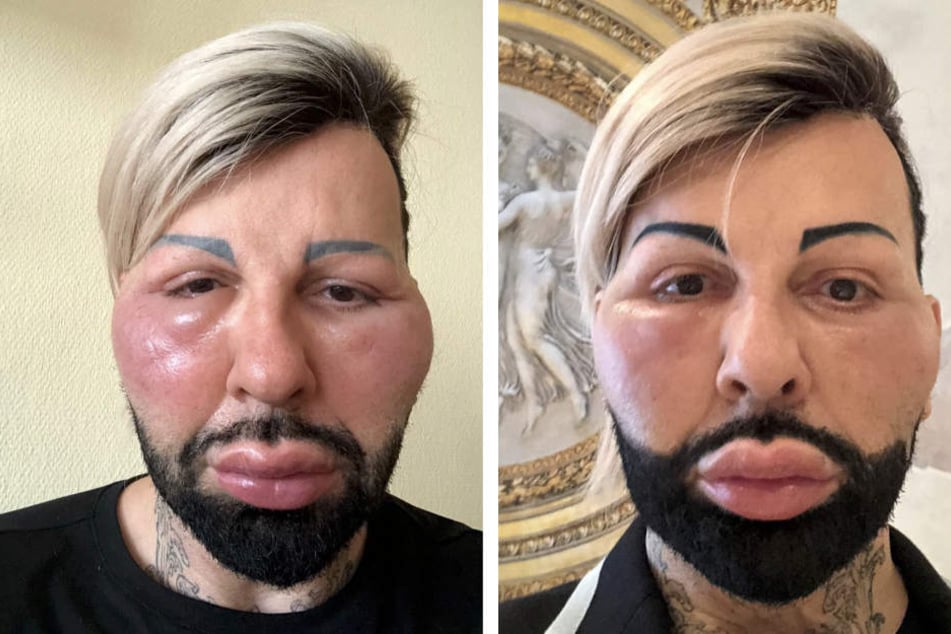 Bereits einen Tag nach seiner allergischen Reaktion hat sich das Gesicht fast wieder normalisiert.