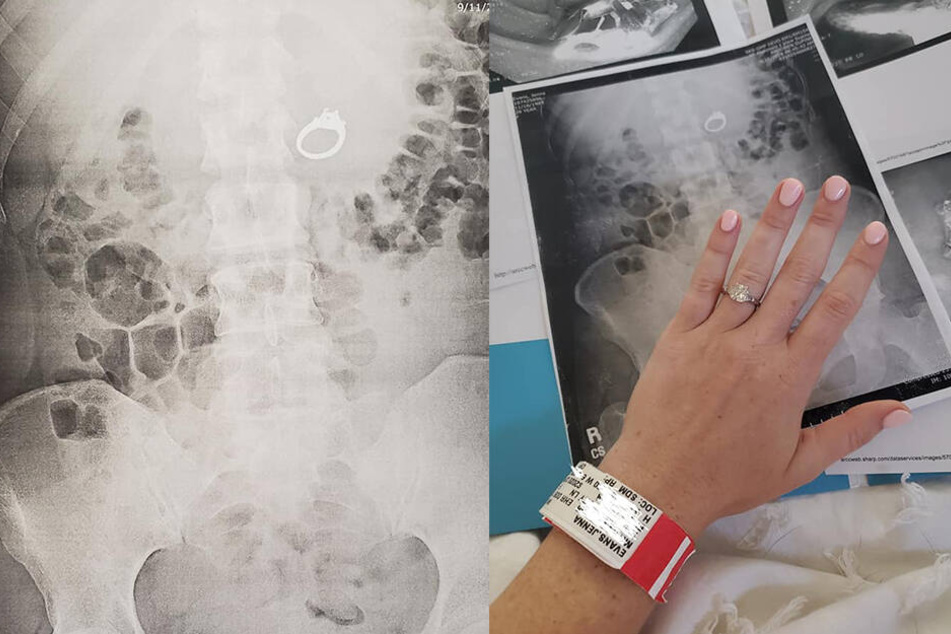 Nachdem ihr der Ring entfernt wurde, bekam sie ihn später von ihrem Verlobten wieder.