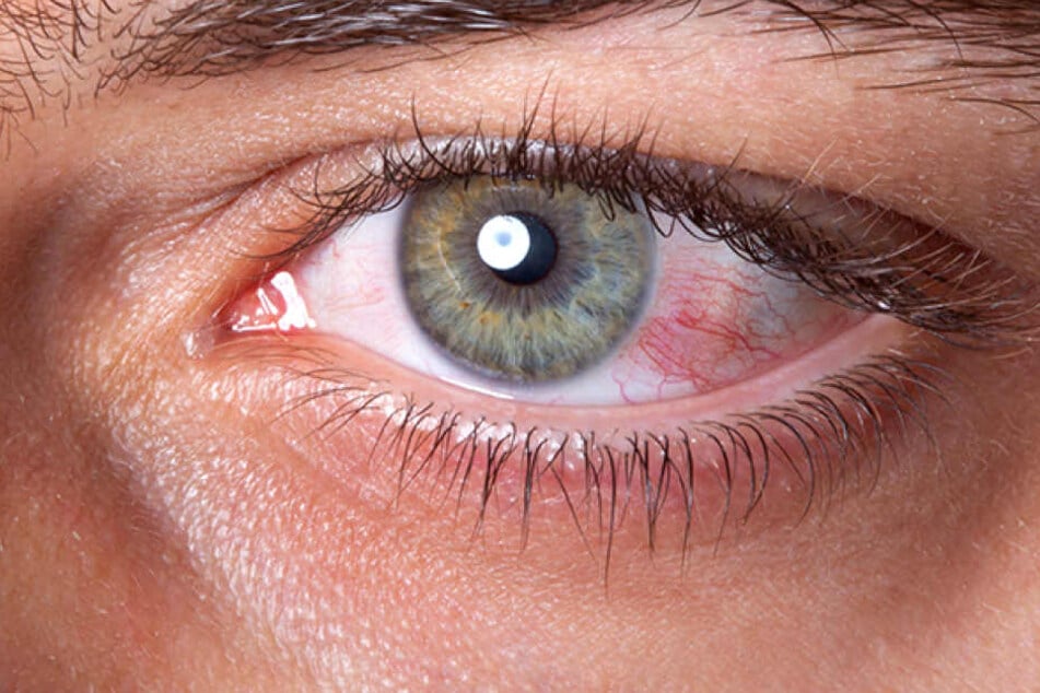 Wurm Im Auge Wurm Im Auge