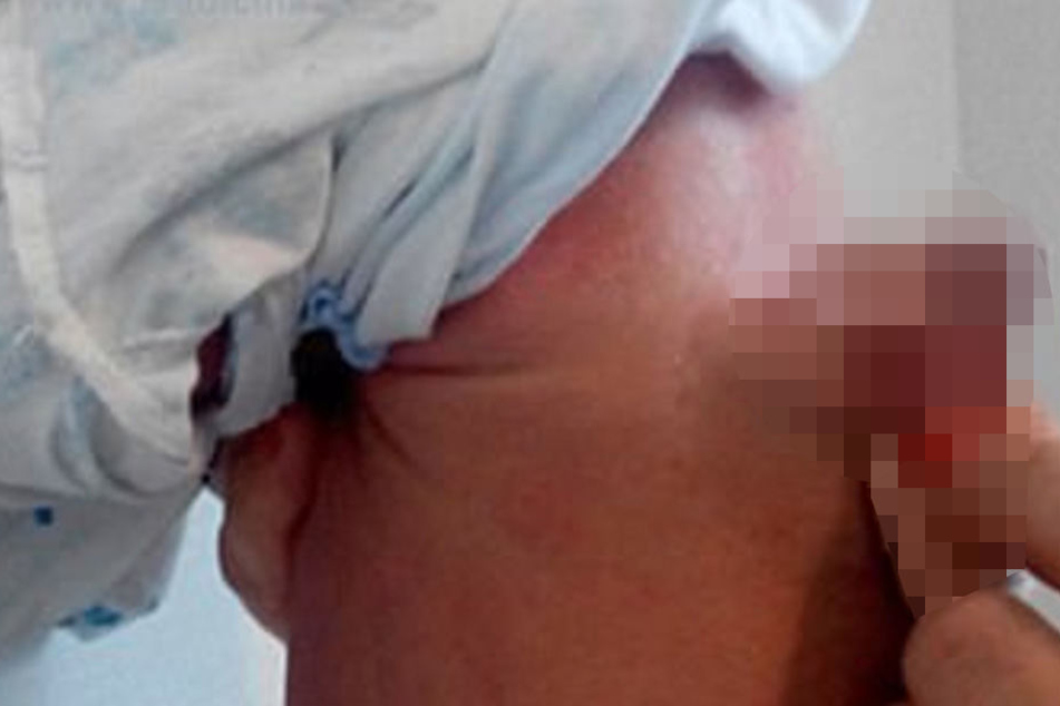 Das Baby kam in Aserbaidschan mit einem zweiten Penis auf die Welt.