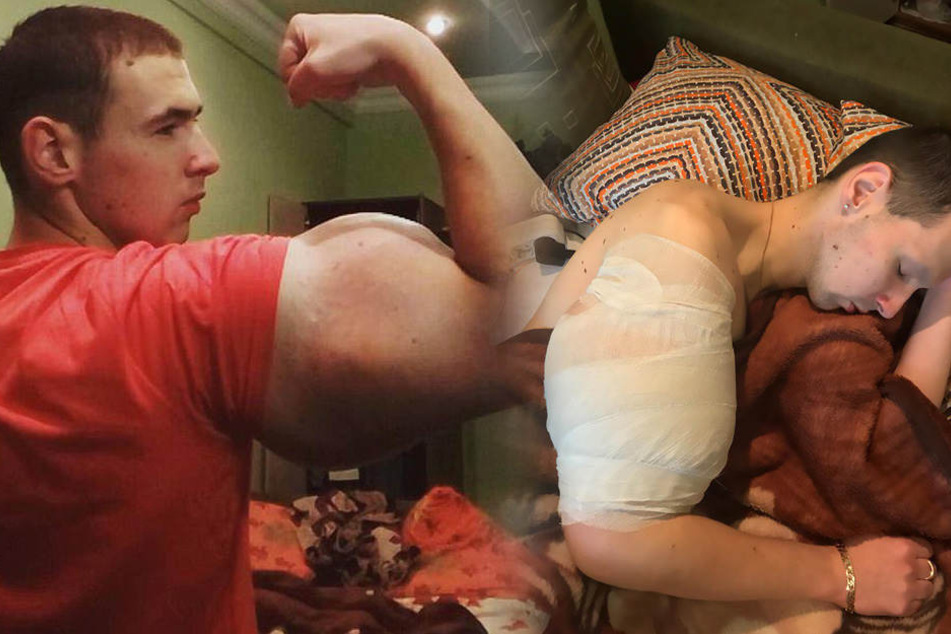 Kiril Tereshin (21) hat es mit seinen Synthol-Injektionen entgültig übertrieben.