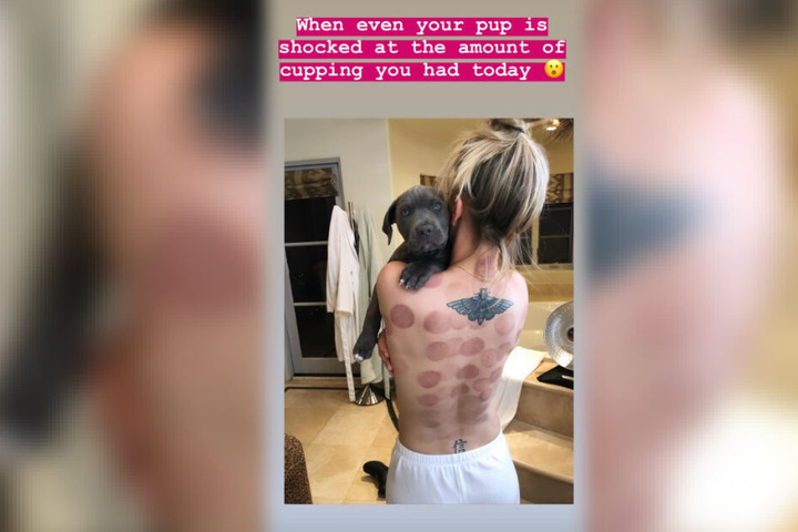 Schauspielerin Kaley Cuoco setzt ganz offensichtlich zur Entspannung auf die Heilmethode des Schröpfens.