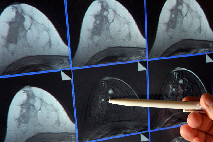Bei diesen Bildern einer Mammographie ist ein winziger Tumor in der Brust einer Patientin zu sehen.