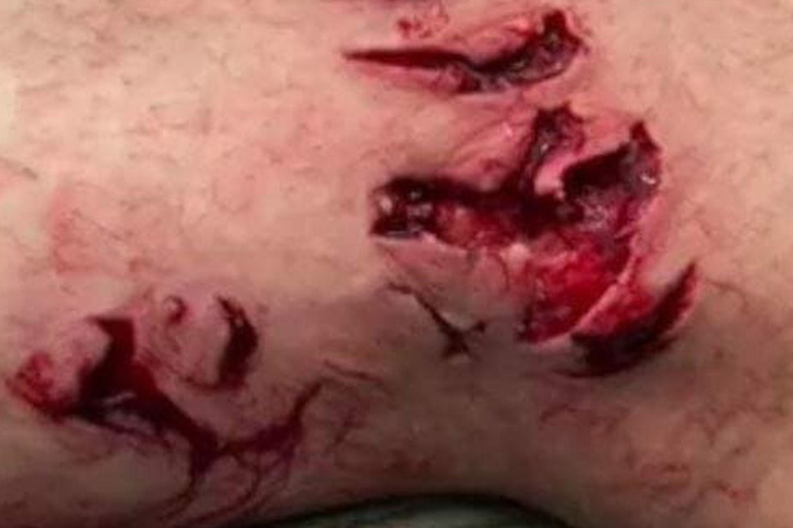 Der US-Amerikaner erlitt schwere Verletzungen an seinem Bein.