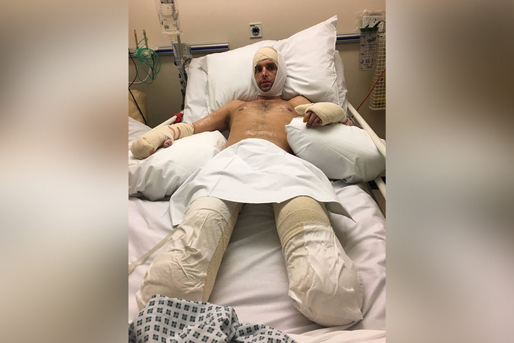 Eingehüllt in dicke Verbände. James musste schon zahlreiche Operationen durchstehen.