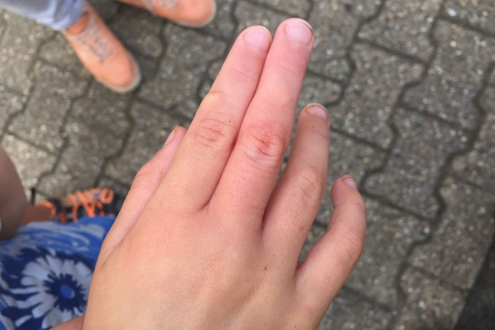 Nach der Rettung war der Finger noch etwa rot.