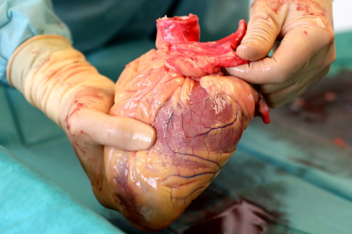 Ein Transplantationsmediziner hält in der Pathologie des Südstadt-Klinikums das Herz eines Verstorbenen in den Händen, das kurz zuvor entnommen wurde (Archivbild).