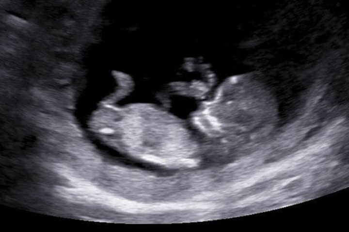 Vor der Geburt postete sie noch stolz Ultraschallbilder auf Facebook.