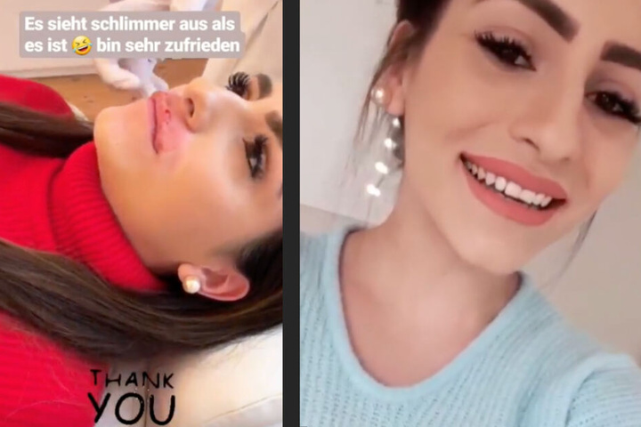 Die 26-Jährige ließ sich ihre Lippen mit Hyaluron unterspritzen.