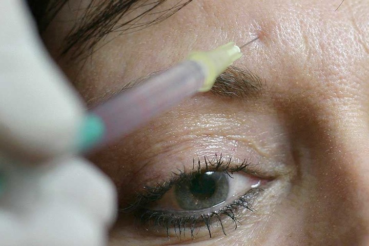 Botox soll sich laut einer Studie negativ auf die sexuelle Zufriedenheit auswirken.