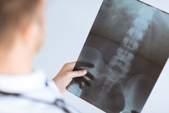 Bei Spritzen im Bereich der Wirbelsäule haben sich mehrere Patienten mit einem gefährlichen Bakterium angesteckt. (Symbolbild)