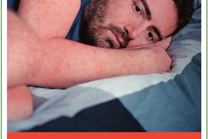 Roter Hautausschlag ist ein Symptom der Masern.