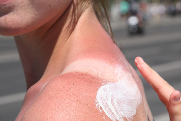 Irgendeine Sonnencreme genügt nicht, sie muss auch auf den Typ abgestimmt sein.