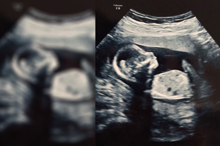 Das Baby wäre mit einem Hirnfehler zur Welt gekommen.