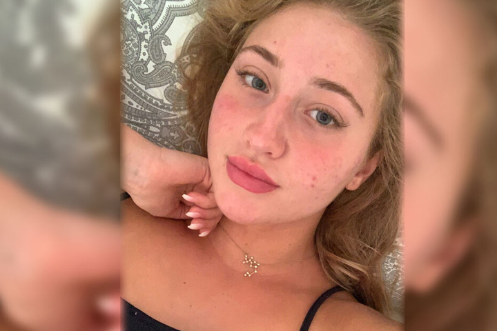 Mit Sommersprossen und roten Stellen: In einer Instagram-Story zeigte Tami Tilgner am Dienstag ihr ungeschminktes Gesicht.
