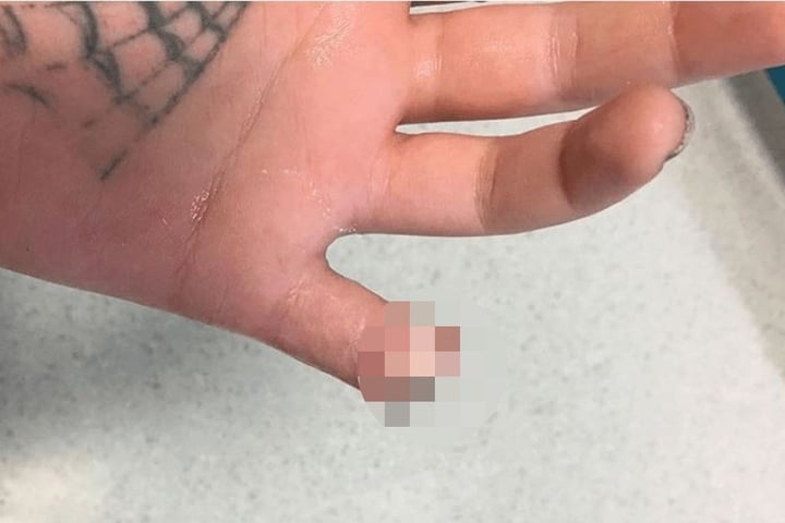 Völlig unnötig: der kleine Finger ist ab!