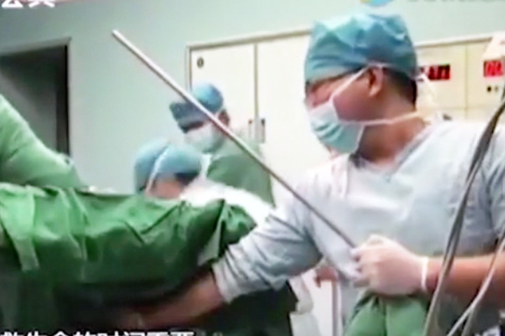 In der Operation wurde dem Mann der Stab über die Schulter herausgezogen.