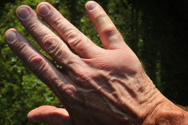 Nach einem Wespenstich ist die Hand angeschwollen. (Symbolbild)