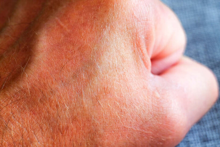 Die 14-Jährige musste nach dem Angriff ambulant von einem Arzt behandelt werden. (Symbolfoto)