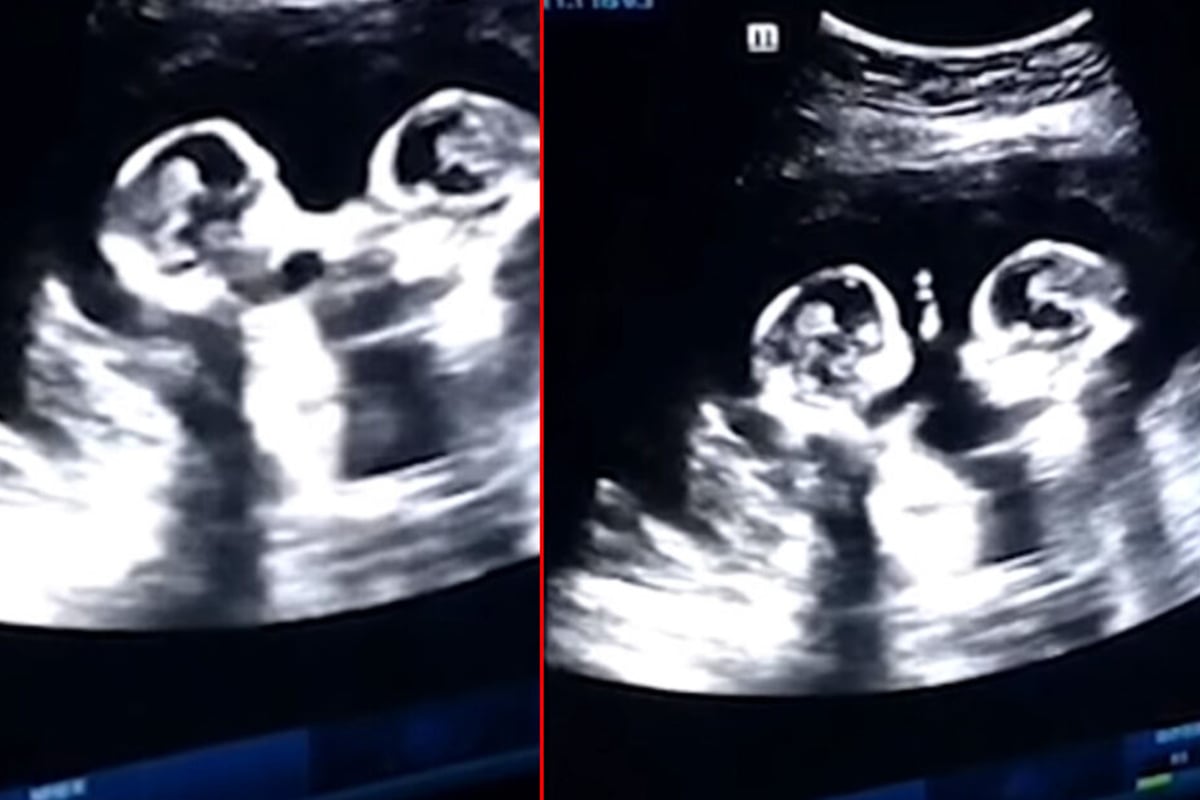 Wahrend Ultraschall Untersuchung Eineiige Zwillinge Kampfen Gegeneinander Tag24