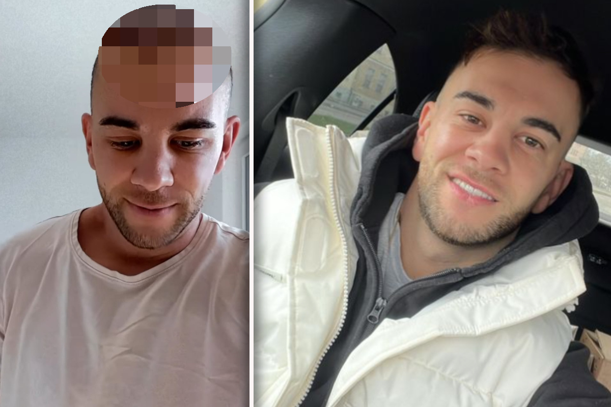 Haar-Transplantation! So sieht Serkan Yavuz (29) nach dem Beauty-Eingriff auf dem Kopf aus