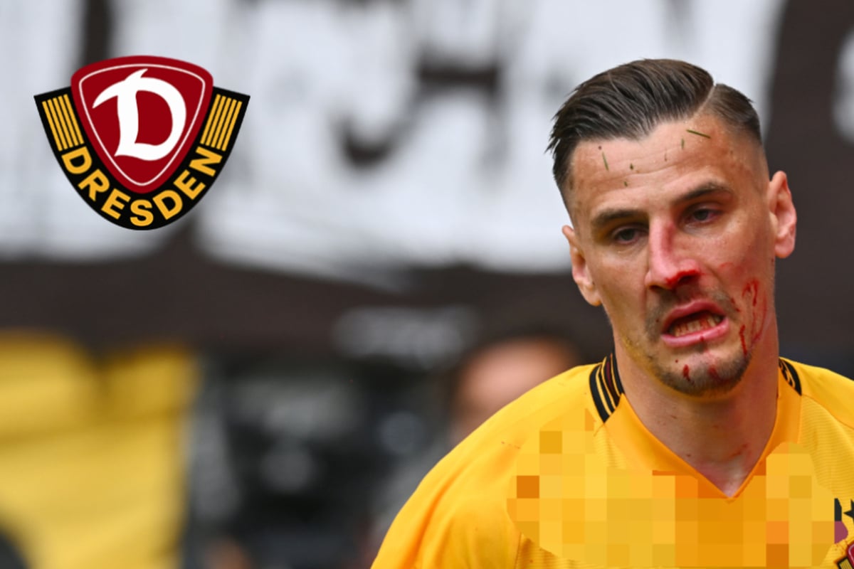 Dynamo Dresden: Stefan Kutschke Hat Sich Die Nase Gebrochen Und Muss ...