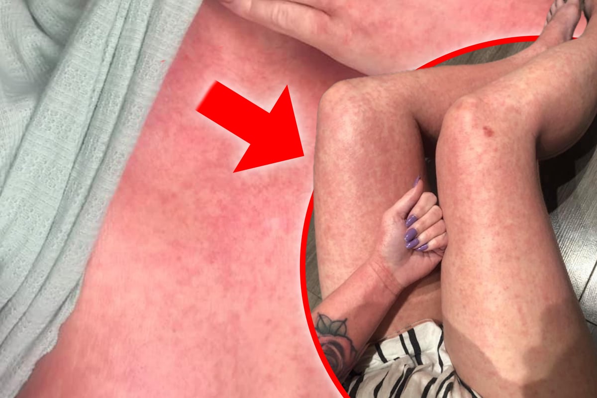 Hautleiden ohne Anerkennung: Betroffene fühlen sich alleingelassen