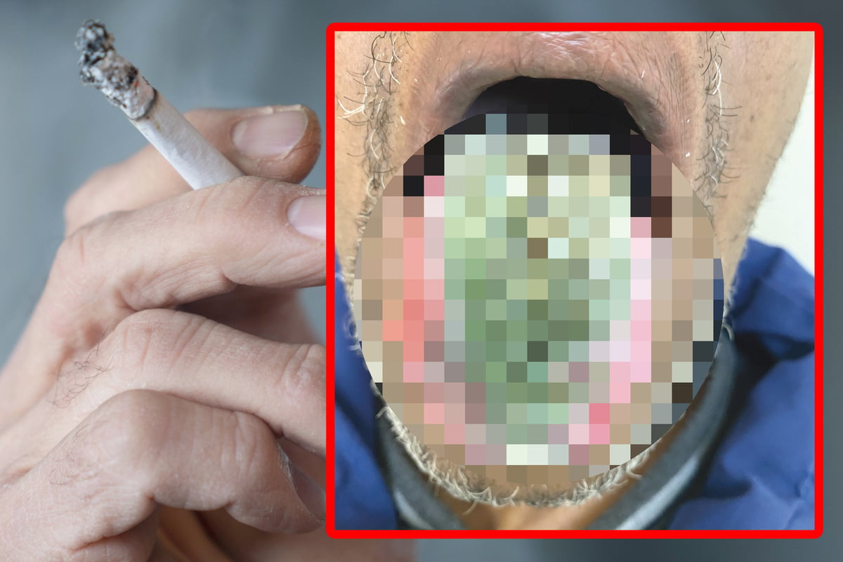 USA Man's Tongue Turns Green and Hairy After Taking Antibiotic ...