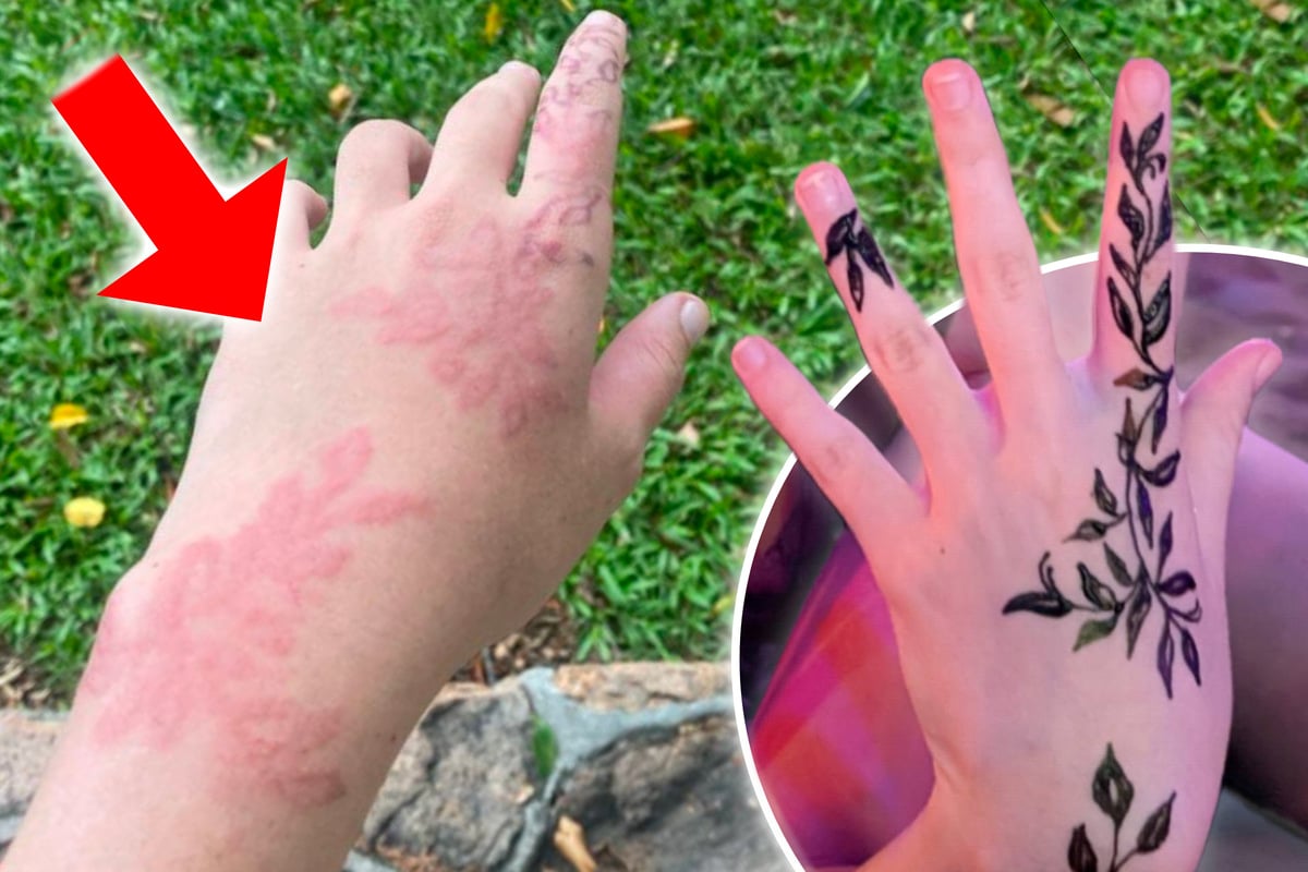 Girl's vacation tattoo turns into a nightmare – with lasting scars