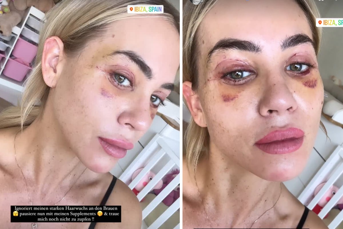 Jessica Haller admite haber recurrido a otros procedimientos de belleza y advierte a sus fans: «¡Por favor, no lo hagan!»