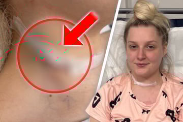 Junge Frau hielt Wölbung für Adamsapfel: Beule am Hals sorgt für Schockdiagnose