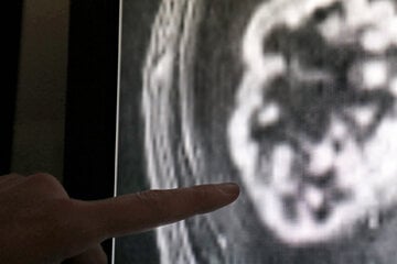 Sachsen-Anhalt nicht mehr Negativ-Spitzenreiter: Weniger Menschen sterben an Krebs