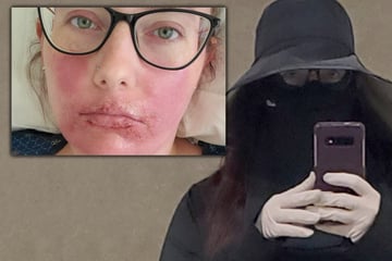 Eine Minute in der Sonne könnte sie töten: Frau lebt seit Jahren wie ein Vampir, und keiner kann helfen