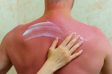 Hautkrebs-Fälle in Kliniken binnen 20 Jahren fast verdoppelt! Das ist der Grund
